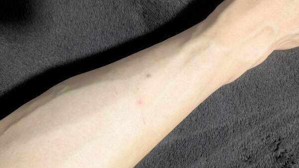 品出しバイト　重いもの　腕の傷　痣